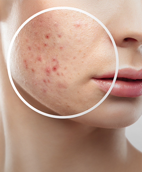 What Causes Acne?
