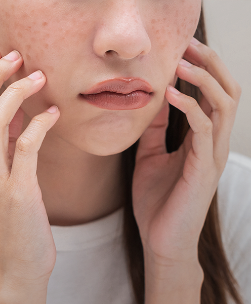 What Causes Hyperpigmentation?