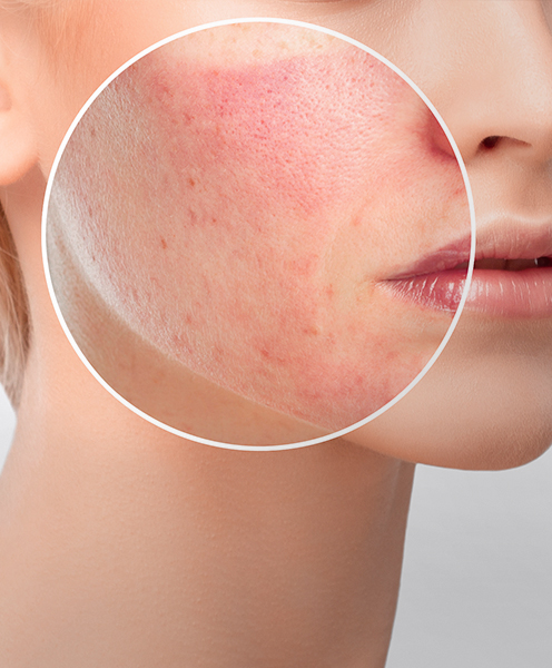 What Causes Sensitive Skin?