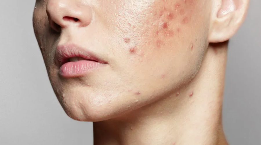 acne scar singapore